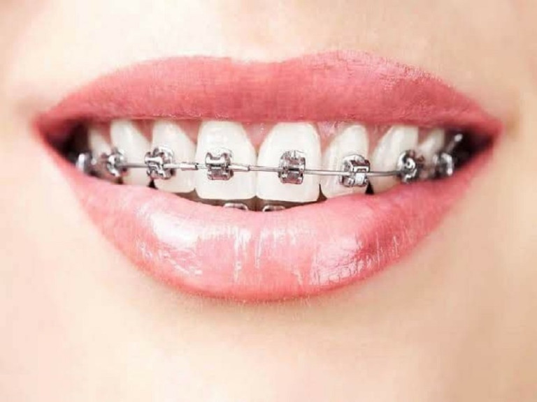 Вниманию всех, у кого ортодонтическая брекет-система система остаётся фиксированной!