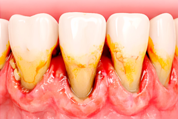 Пародонтит 