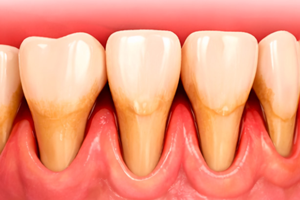 Пародонтоз